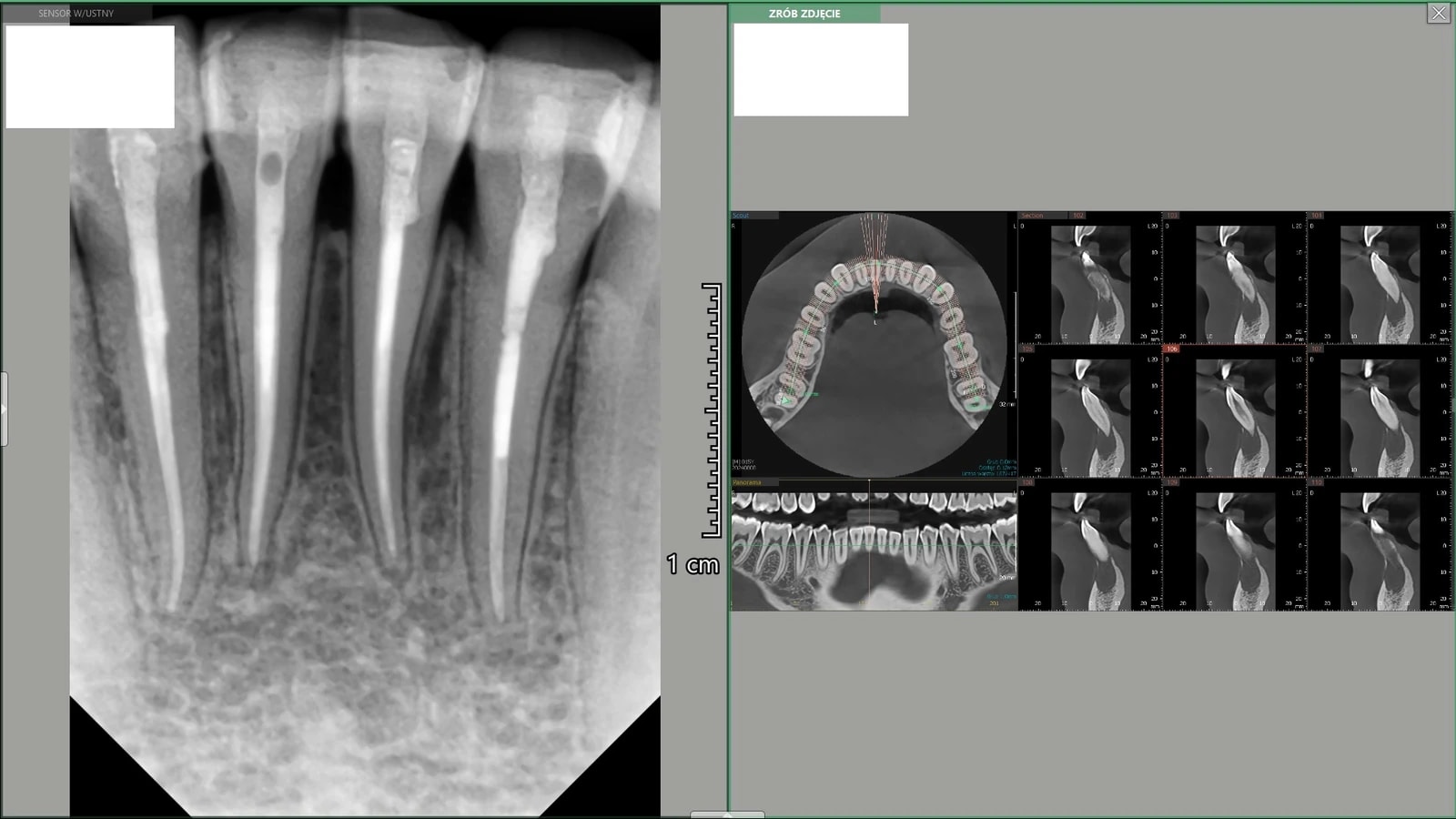 RTG przed leczeniem endodontycznym - widoczna rozległa torbiel zębopochodna w okolicy siekaczy żuchwy.