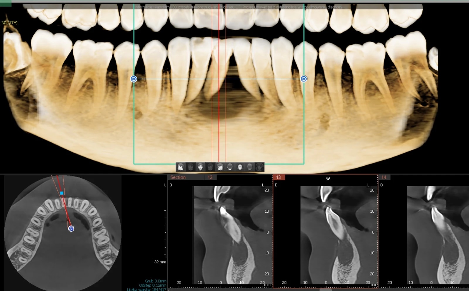 Kontrolne RTG w trakcie obserwacji gojenia torbieli zębopochodnej po leczeniu endodontycznym.