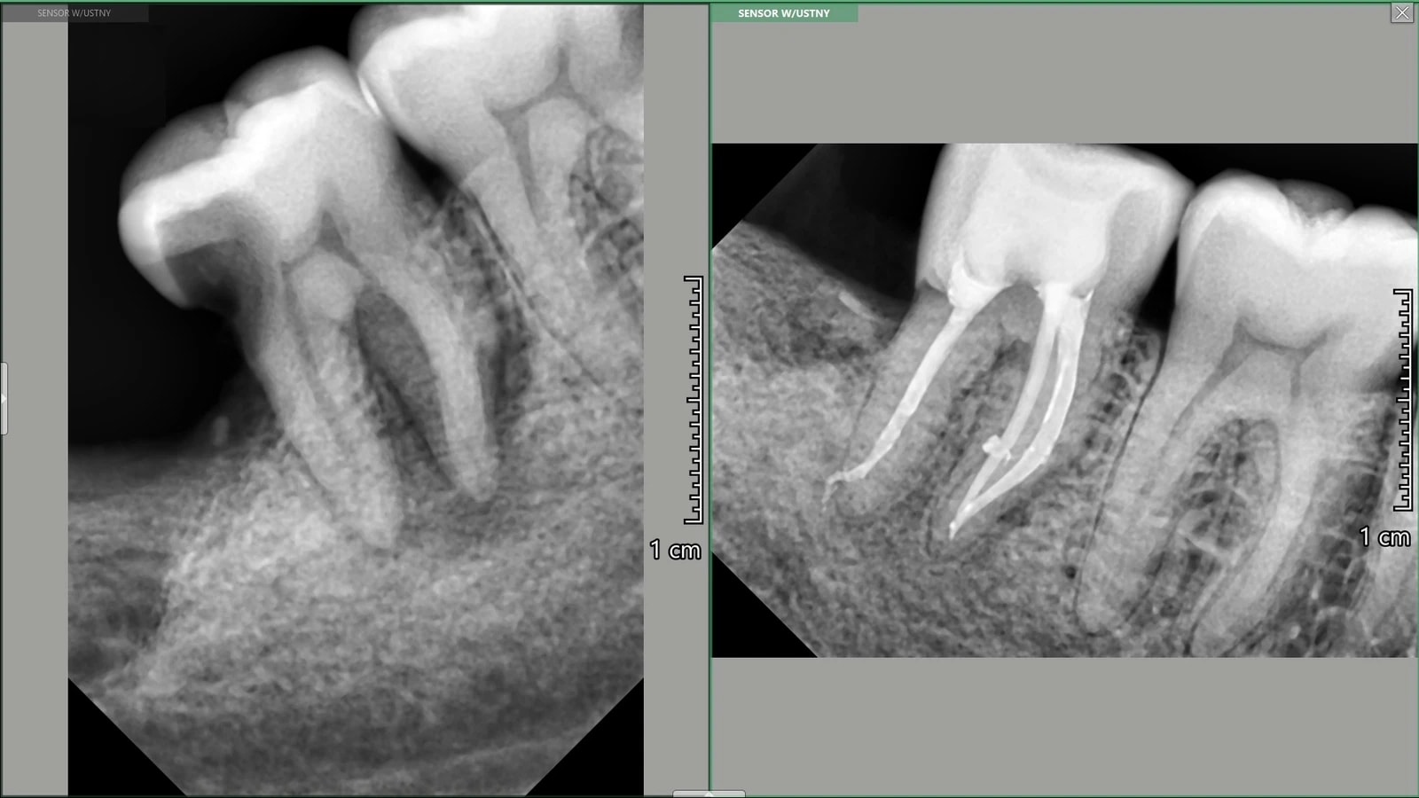 RTG dokumentujące leczenie endodontyczne i gojenie zapalnej zmiany okołowierzchołkowej z odbudową zęba.