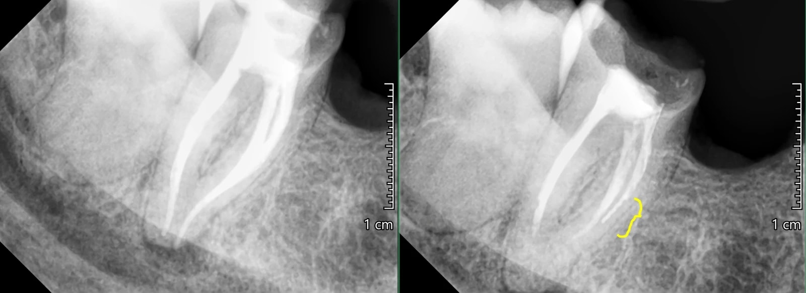 RTG dokumentujące ponowne leczenie endodontyczne i usunięcie pozostawionego narzędzia z kanału korzeniowego.