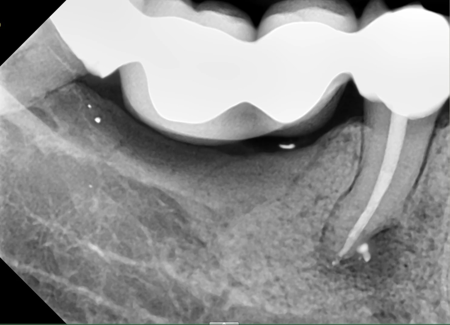 Kontrolne RTG po ponownym leczeniu endodontycznym przez koronę mostu metalowo-porcelanowego.