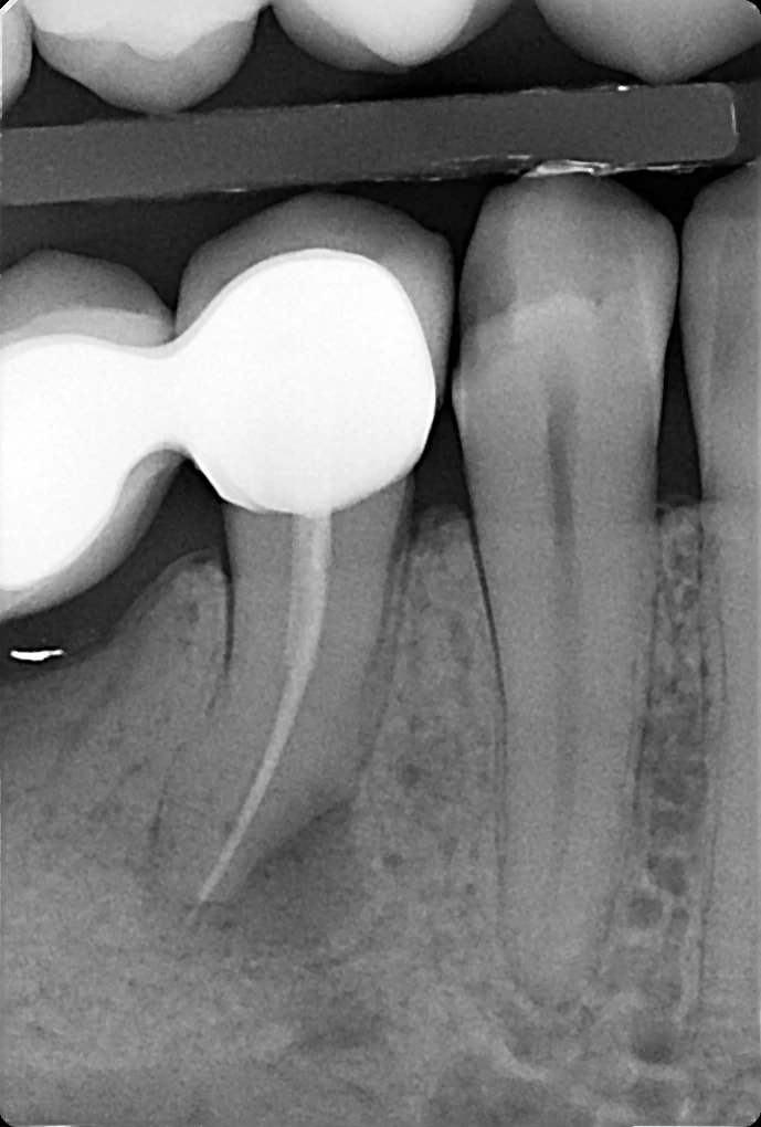RTG przed ponownym leczeniem endodontycznym przez koronę mostu - widoczna zmiana okołowierzchołkowa.