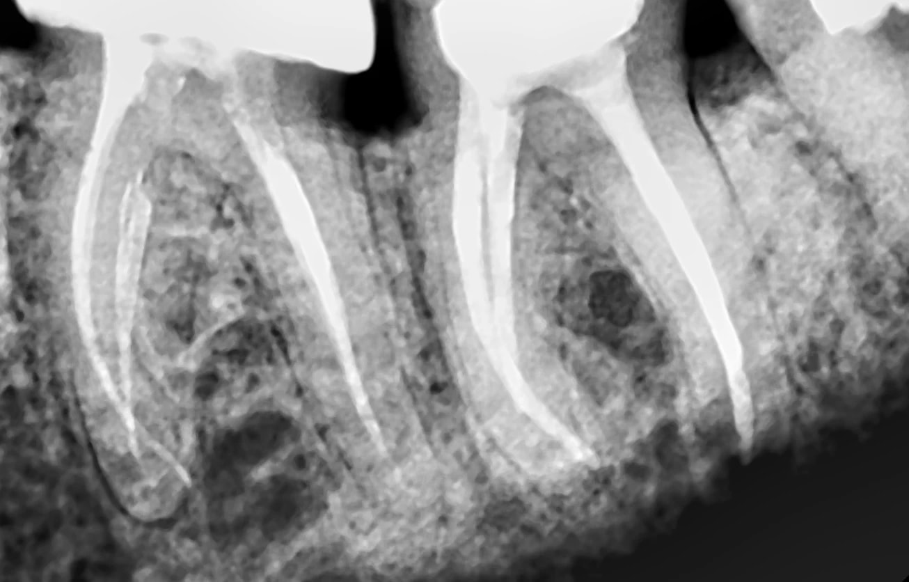 Kontrolne RTG po ponownym leczeniu endodontycznym i usunięciu fragmentu narzędzia z kanału dystalnego.