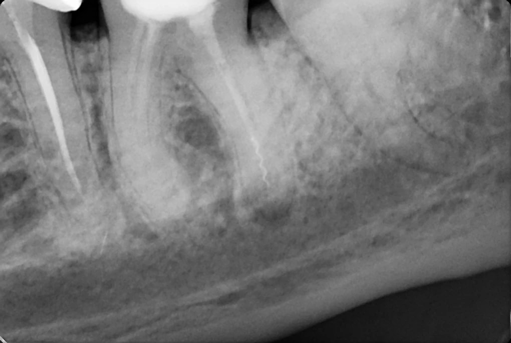 RTG przed ponownym leczeniem endodontycznym - widoczny fragment narzędzia w kanale dystalnym.