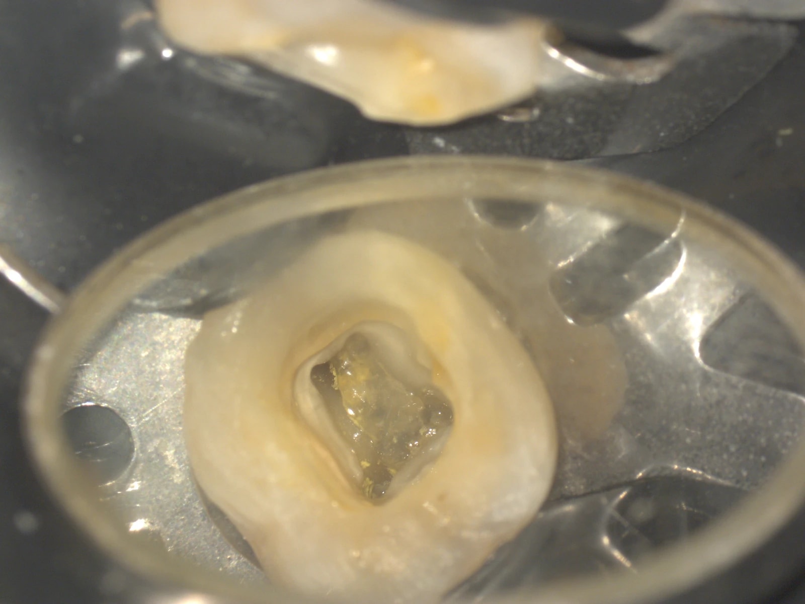 Obraz śródzabiegowy pod mikroskopem - etap 1 leczenia endodontycznego.