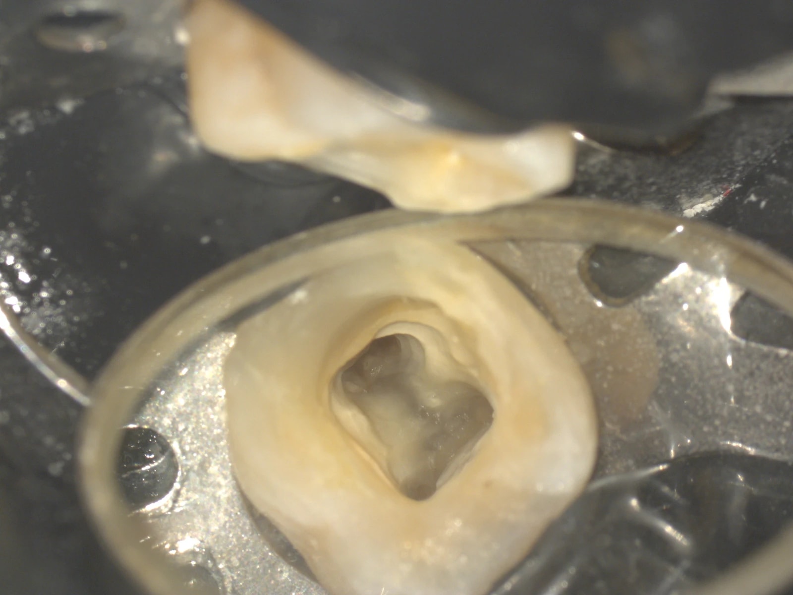 Obraz śródzabiegowy pod mikroskopem - etap 2 leczenia endodontycznego.