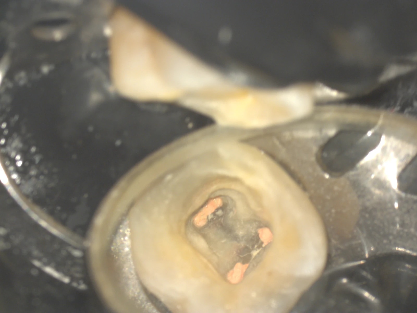 Obraz śródzabiegowy pod mikroskopem - etap 3 leczenia endodontycznego.